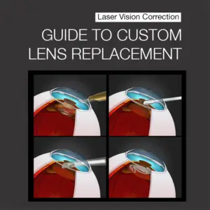 A series of four images illustrating the custom lens replacement surgery: Making 2-3 tiny incisions at the edge of the cornea; Emulsifying and removing the natural lens; Inserting a new multifocal lens; New lens in place, showing improved vision.