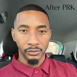 Leroy after PRK vision correction