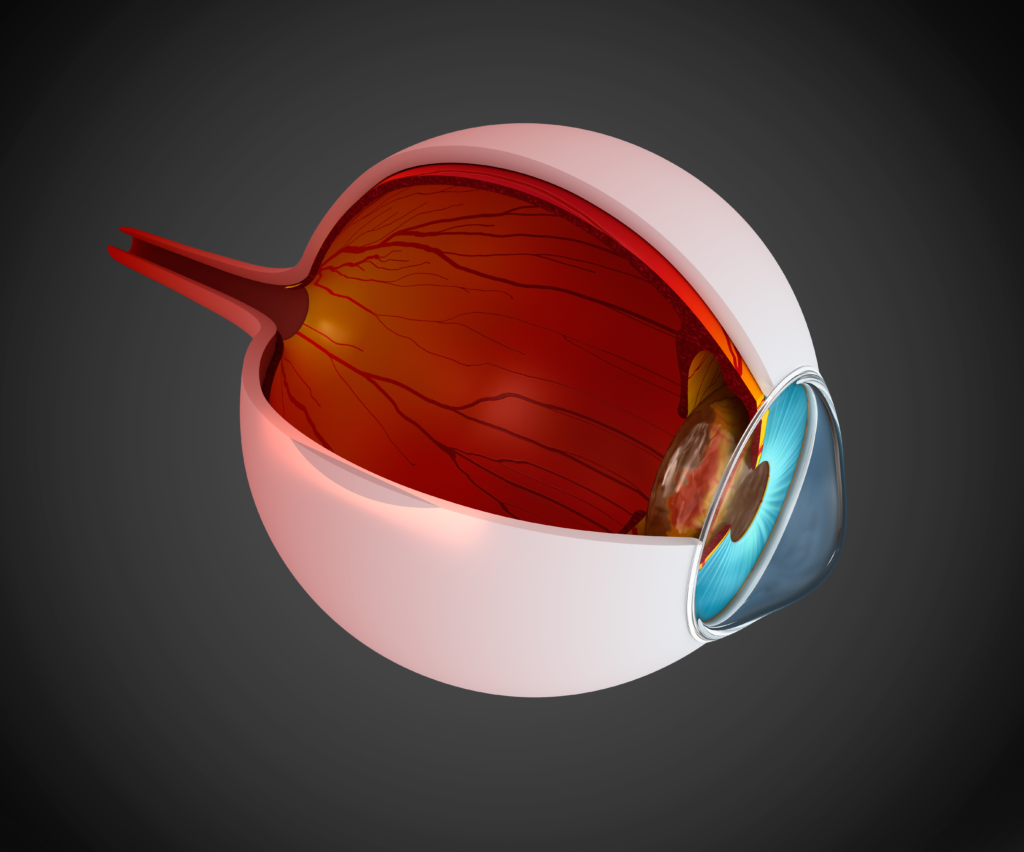 Keratoconus Vision