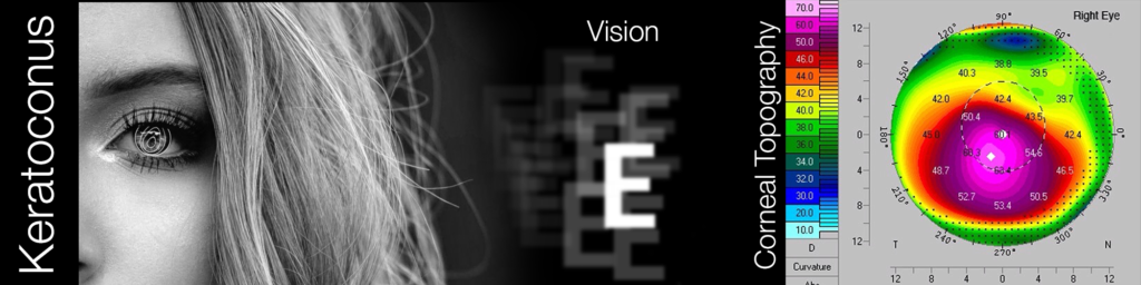 Keratoconus Vision test