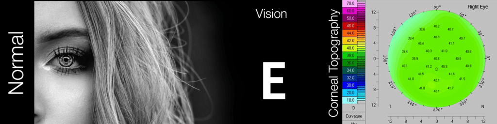 Normal Vision Topography