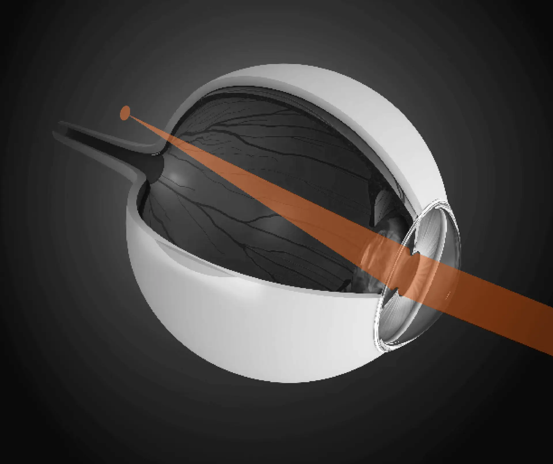 LASIK: See the World as It’s Meant to Be Seen 2