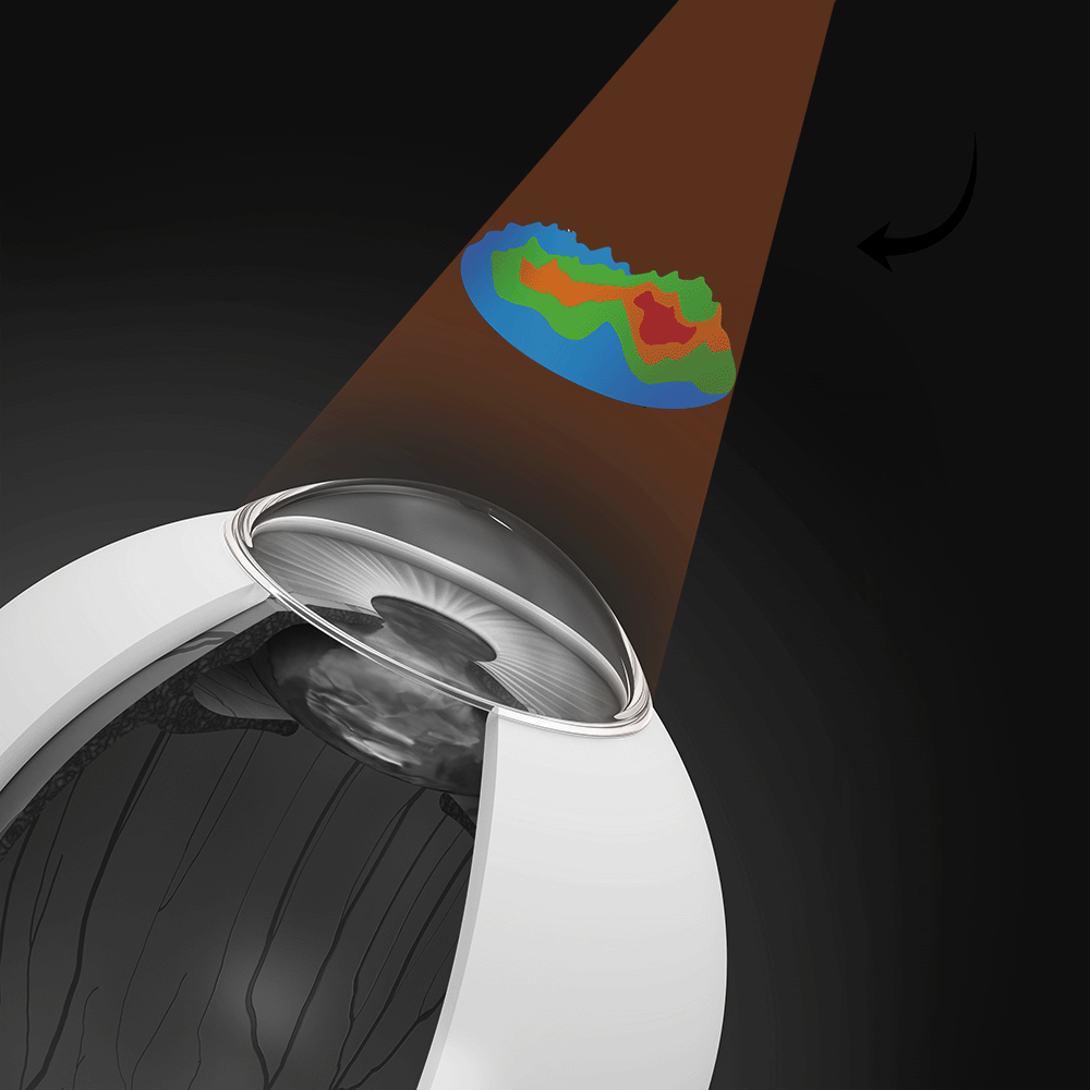 LASIK: See the World as It’s Meant to Be Seen 5 Illustration of an eye undergoing a corneal topography scan before LASIK surgery, projecting a colour-coded map that shows the shape and thickness of the cornea.