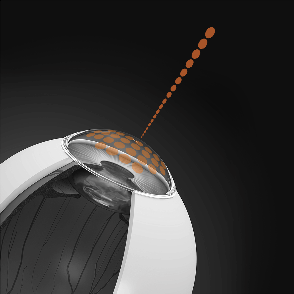 LASIK: See the World as It’s Meant to Be Seen 7 Illustration of a femtosecond laser creating a thin flap on the surface of the cornea during the LASIK procedure, shown as a precise beam targeting the eye.