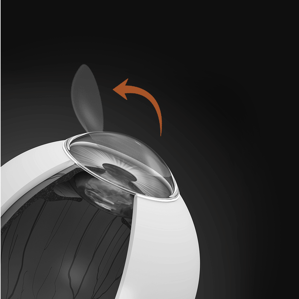 LASIK: See the World as It’s Meant to Be Seen 8 Illustration of the corneal flap being gently lifted after laser creation during LASIK surgery, allowing access to the underlying corneal tissue for reshaping.