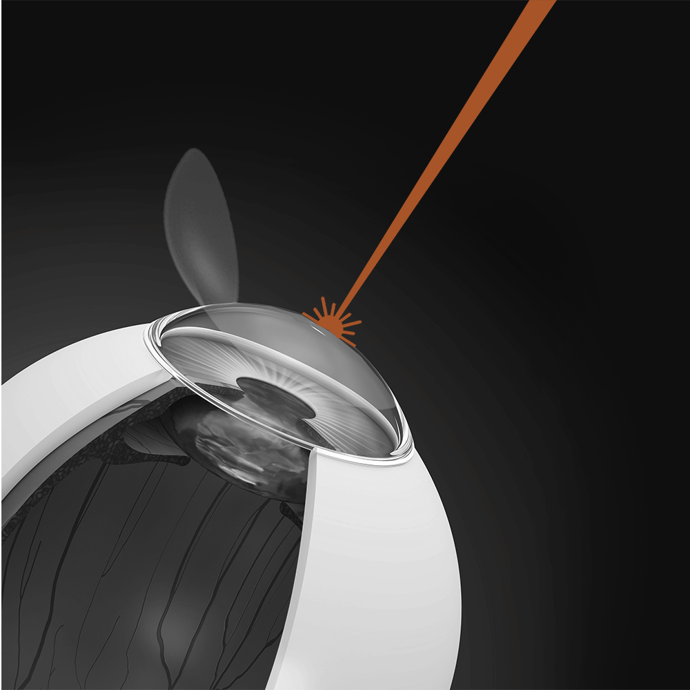 LASIK: See the World as It’s Meant to Be Seen 9 Illustration showing an excimer laser precisely reshaping the underlying corneal tissue during LASIK surgery, after the flap has been lifted, to correct vision.