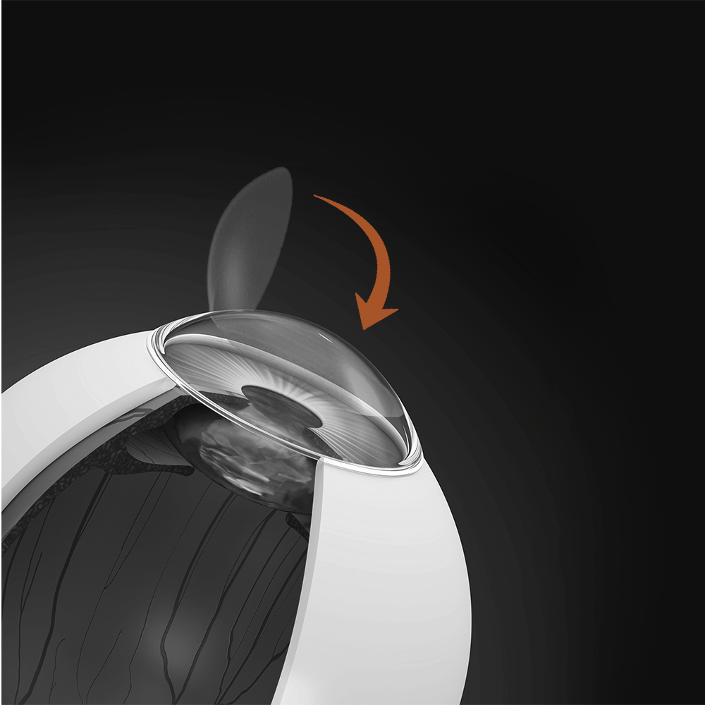 LASIK: See the World as It’s Meant to Be Seen 10 Illustration showing the corneal flap being gently repositioned after laser reshaping during LASIK surgery, completing the vision correction procedure.